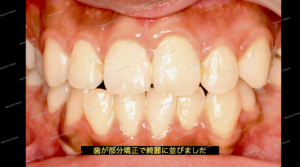 部分矯正による歯のガタガタ、反対咬合（叢生）が治りました。